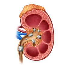 cálculo renal